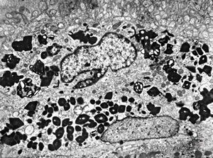 M,58y. | crystalline inclusions in hepatocyte after unknown medication